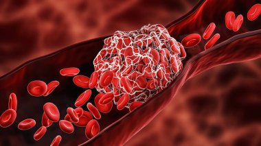 Blood Clot or thrombus blocking the red blood cells stream within an artery or a vein 3D rendering illustration. Thrombosis, cardiovascular system, medicine, biology, health, anatomy, pathology concepts. clipart