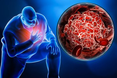 Obez ya da kilolu bir adam kalp krizi geçiriyor ya da pulmoner embolizm geçiriyor. Kan pıhtısının yakın plan görüntüsü üç boyutlu. İlaç, tıbbi durum, patoloji, fiziksel acı, sağlık kavramları.