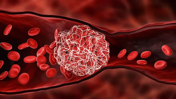 動脈内の赤血球の流れを妨げる血栓または血栓 または静脈3Dレンダリング図 血栓症 心血管系 生物学 解剖学 病理学の概念 — ストック写真