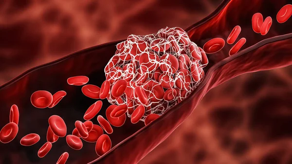 Blood Clot Thrombus Blocking Red Blood Cells Stream Artery Vein — Stock Photo, Image