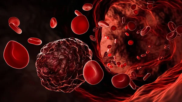 Célula Cancerosa Tumor Canceroso Medio Glóbulos Rojos Que Fluyen Vaso —  Fotos de Stock