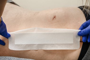 Hemşirenin elleri rutin bir pansuman sırasında ameliyat sonrası dikişe bir yama uygular..