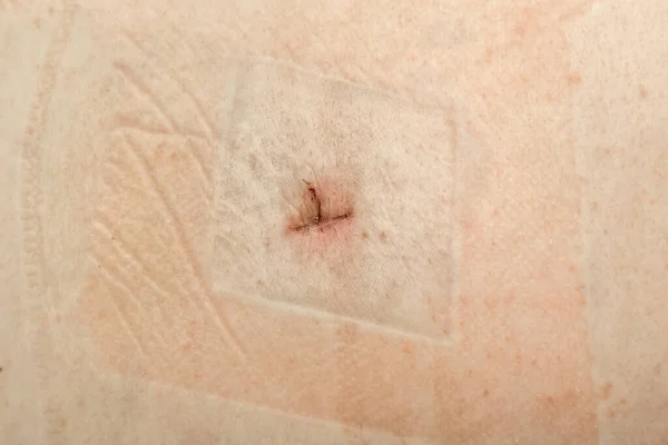 Cicatrice Sutura Guarigione Dopo Piccolo Intervento Chirurgico Sulla Pelle Umana — Foto Stock