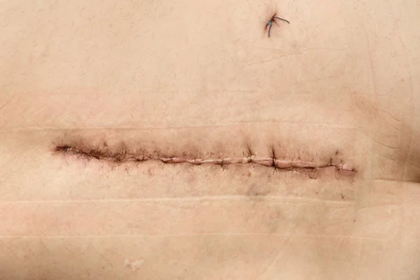 Surgery Hip Postoperative Suture Skin Iodine Stitched Skin Operation — Stock Photo, Image