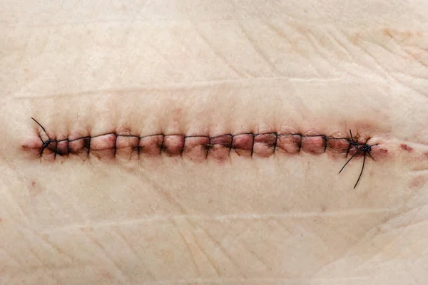 术后在人的皮肤上缝合线 髋部用黑色医用螺纹缝合线缝合 术后用碘在皮肤上缝合线 不要在手术后把皮肤弄皱了 图库照片
