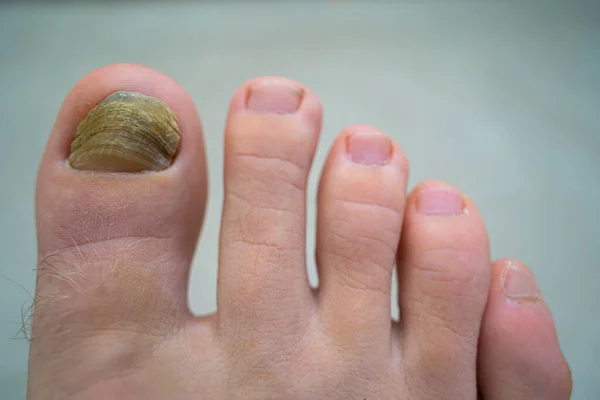 Fungus on a man\'s big toe. Close-up of a nail. Fungus of the nail.