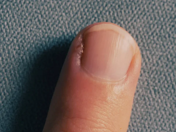 指にキューティクルが炎症を起こした 指の損傷部分 クローズアップ — ストック写真