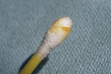 Pamuklu çubukta kulak kiri, makro fotoğraf. Kulak kiri ya da serumen (İngilizce: 