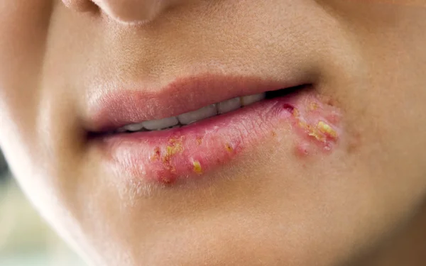 Herpes på läpparna — Stockfoto