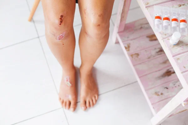 Fractured knees of girl — Stock Photo, Image