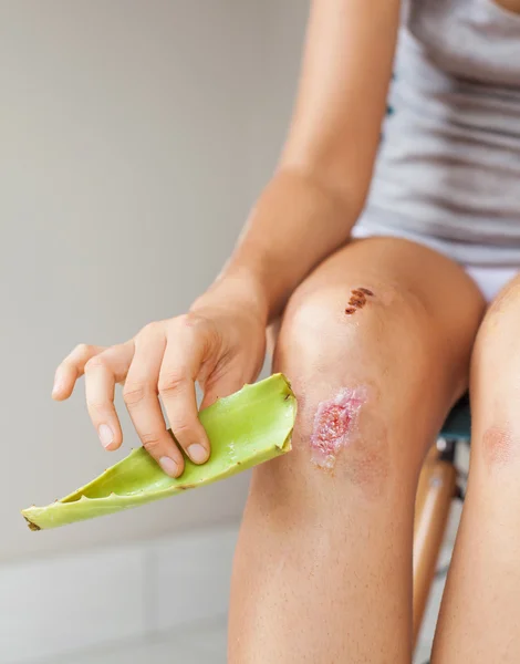 Frau desinfiziert ihre Wunde mit Aloe — Stockfoto