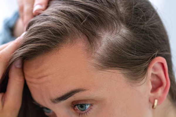 Femme Souffrant Perte Cheveux Traitement Des Problèmes Cheveux — Photo