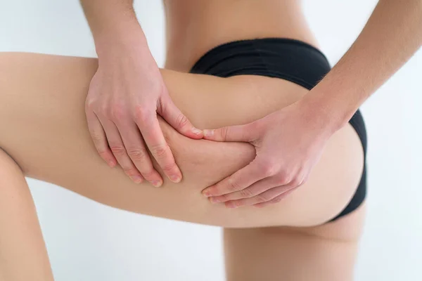 Vrouwelijke Benen Met Cellulitis Behandeling Preventie Probleem Lichaamshuid Gezonde Huid — Stockfoto