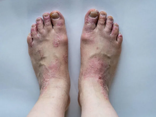 Closeup of the legs of a woman suffering from chronic psoriasis on a white background. Closeup of rash and scaling on the patients skin. Dermatological problems. Dry skin. Isolated.