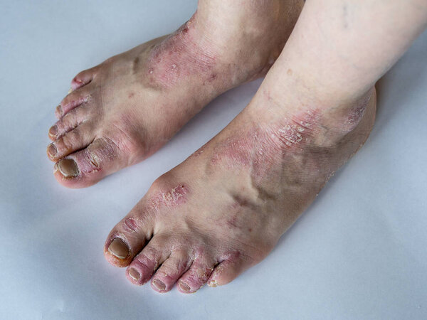 Closeup of the legs of a woman suffering from chronic psoriasis on a white background. Closeup of rash and scaling on the patients skin. Dermatological problems. Dry skin. Isolated.