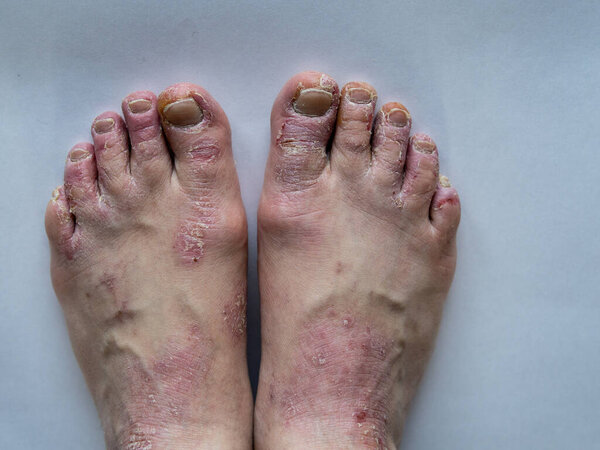 Closeup of the legs of a woman suffering from chronic psoriasis on a white background. Closeup of rash and scaling on the patients skin. Dermatological problems. Dry skin. Isolated.