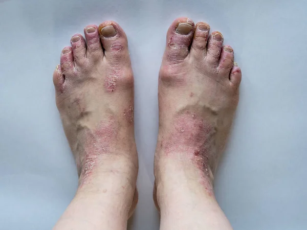 Pendekatan kaki seorang wanita yang menderita psoriasis kronis pada latar belakang putih. Penutup ruam dan scaling pada kulit pasien. Masalah Dermatologi. Kulit kering. Terisolasi. Stok Gambar