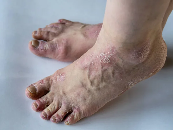 Pendekatan kaki seorang wanita yang menderita psoriasis kronis pada latar belakang putih. Penutup ruam dan scaling pada kulit pasien. Masalah Dermatologi. Kulit kering. Terisolasi. Stok Gambar Bebas Royalti