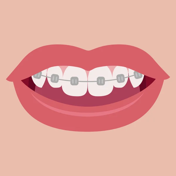 dişlerde diş telleri.