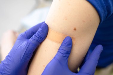 Covid-19 aşısı, sağlık sigortası, vücut konseptinde doğum lekeleri. Eldivenli doktorun elleri kişiye tıbbi alçı yapıştırıyor. Hastanın ellerinde pürüzlü kenarları olan büyük bir ben var..