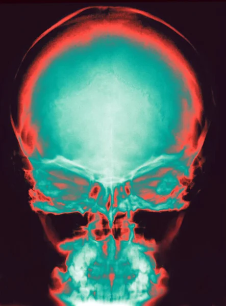 人类头骨的X光照片 — 图库照片