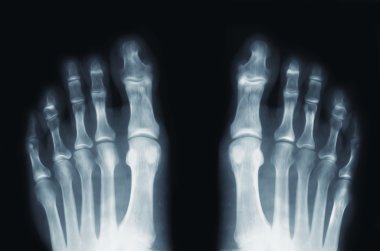 x-ışını feet