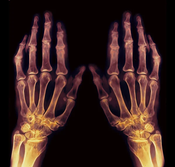 X-ışını eli — Stok fotoğraf