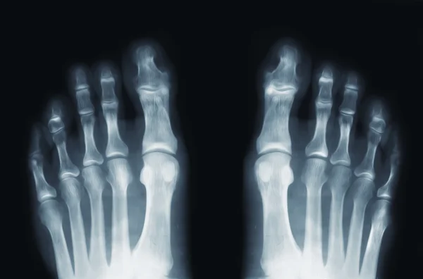 Πόδια x-ray — Φωτογραφία Αρχείου