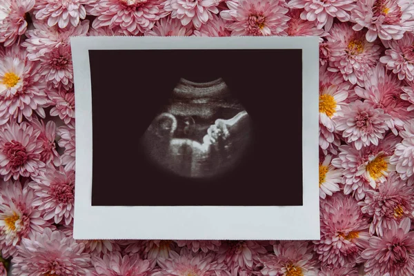 Photo of ultrasound examination of a child during pregnancy of the mother in the second and third trimester close-up against the background of pink chrysanthemum flowers, the concept of waiting