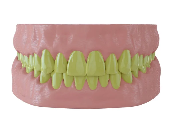 Lidská Čelist Žlutými Zuby Vykreslení — Stock fotografie