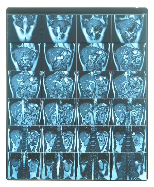 Mri スキャン画像 — ストック写真