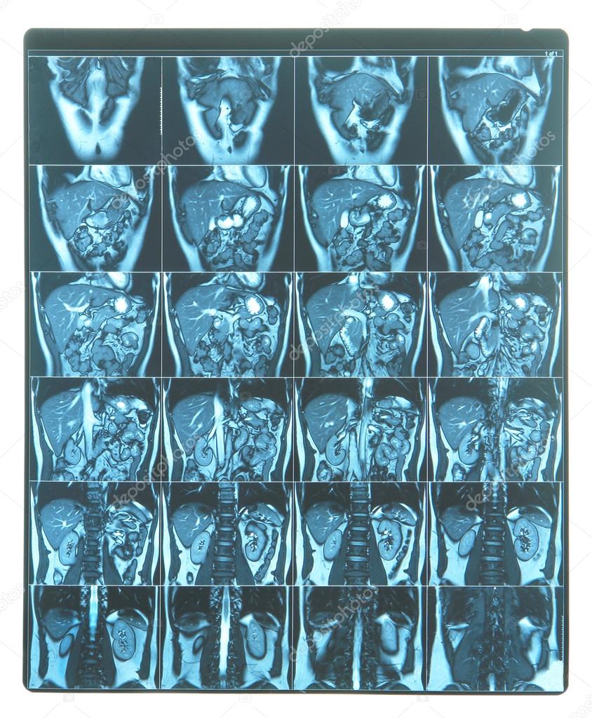 MRI scan image