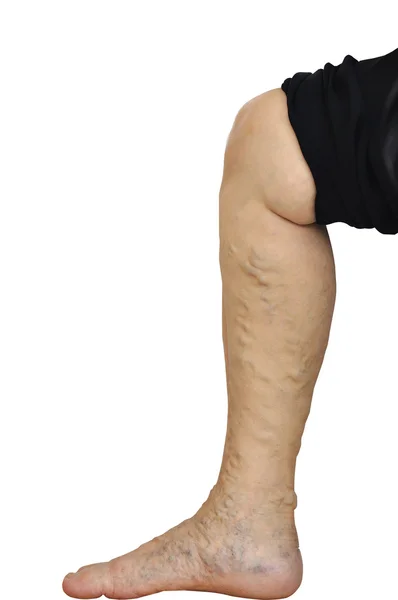 Нога старухи Азии на белом фоне, варикозное расширение вен — стоковое фото