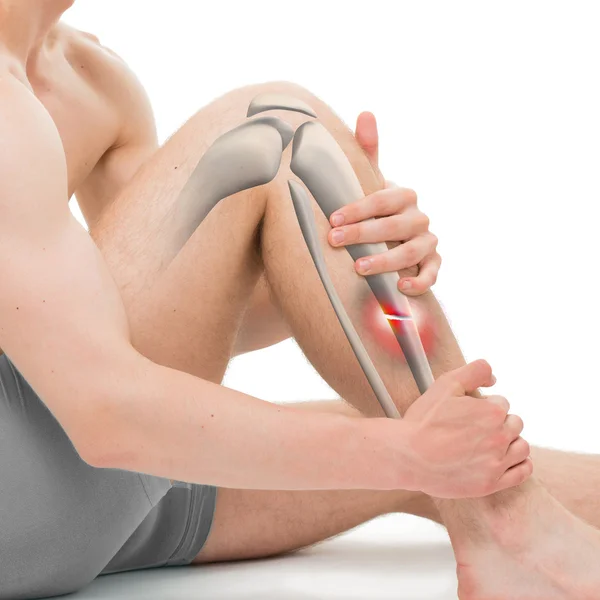 Поперечный перелом большеберцовой кости - трехмерная иллюстрация перелома ноги Стоковая Картинка