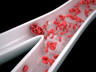Sickle Cells Blocking Blood Flow clipart