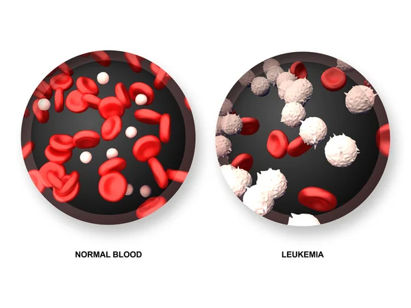 Leukemi vs normal blod — Stockfoto