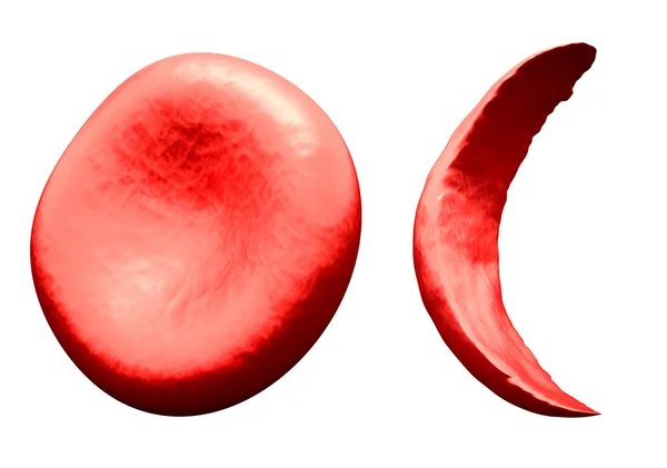 Normalny vs sierp krwinek czerwonych — Zdjęcie stockowe