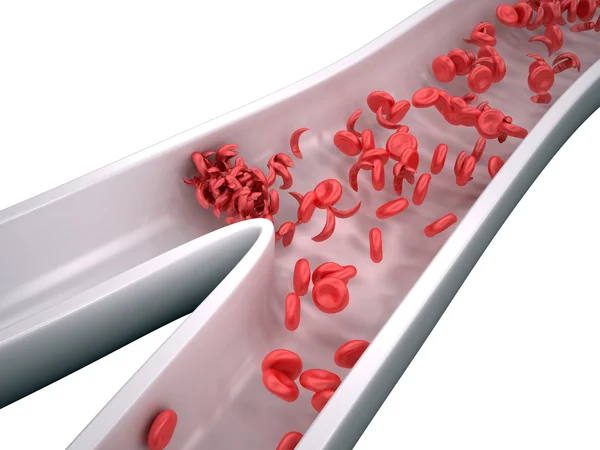 Sierp komórki blokuje przepływ krwi - na białym tle — Zdjęcie stockowe