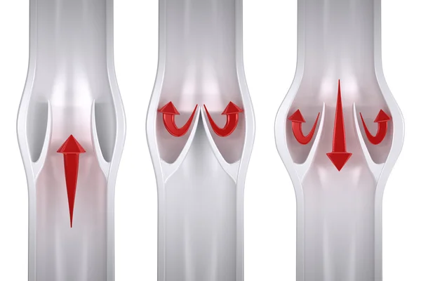 Normalny vs żylaków - anatomia żył — Zdjęcie stockowe