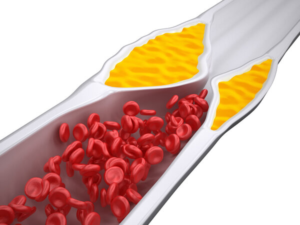 Засоренная артерия - атеросклероз Атеросклероз - Налет на холестерин - iso view
