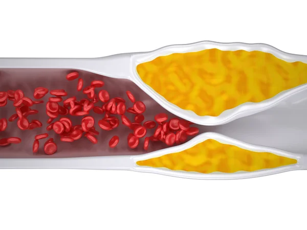 Clogged Artery - Atherosclerosis Arteriosclerosis - Cholesterol plaque - top view — Stock Photo, Image