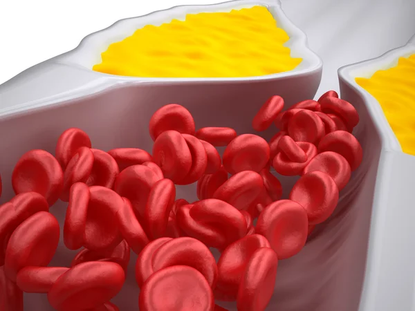 Zatkane tętnicy - miażdżycę Miażdżyca - tablica cholesterolu - szczegółowe informacje — Zdjęcie stockowe