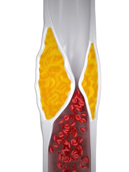 Verstopfte Arterie - Arteriosklerose Arteriosklerose - Cholesterinplaque - Draufsicht — Stockfoto