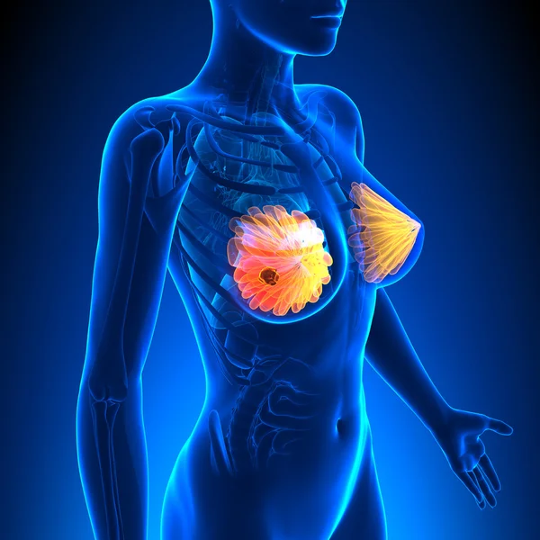 Рак молочної залози - жіноча анатомія - висвітлення пухлини — стокове фото
