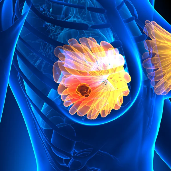 Рак молочной железы - женская анатомия - изолированы на белом — стоковое фото