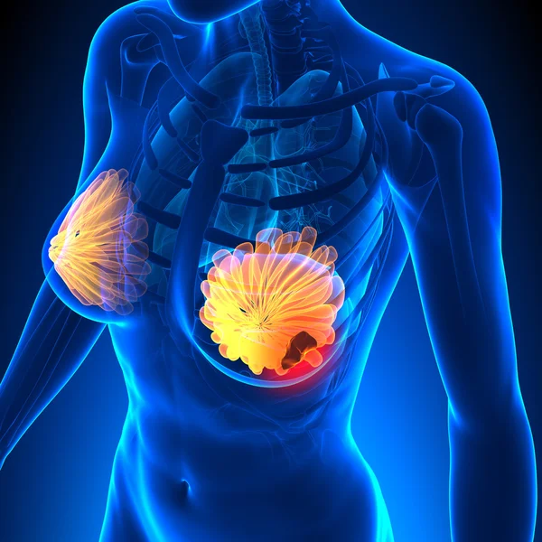 Breast Cancer - Female Anatomy - tumor highlight — Stock Photo, Image