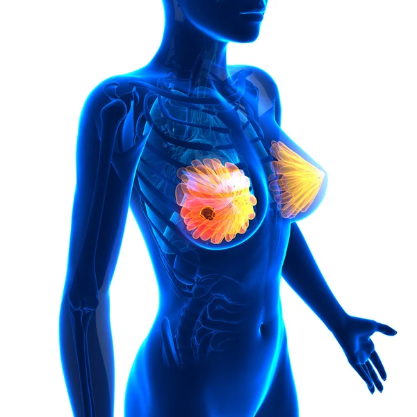 Рак молочної залози - жіночій анатомії - ізольовані на білому — стокове фото