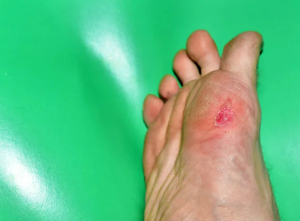 Callus on the foot on a male foot. Human leg with a wound. Corns and calluse. Skin dermatology problem. Monitor feet skin condition to prevent skin breakdown and trauma. Safefoot wear. Diabetes