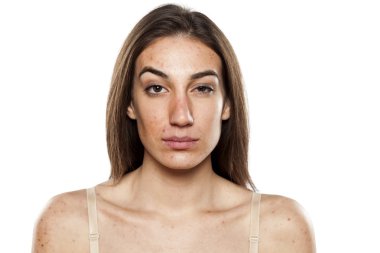 sorunlu cilt kadınlarla