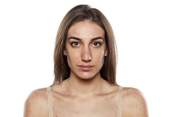 Women with problematic skin — Stock Photo, Image